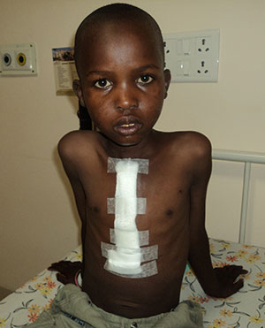 A young Kenyan boy after heart surgery.